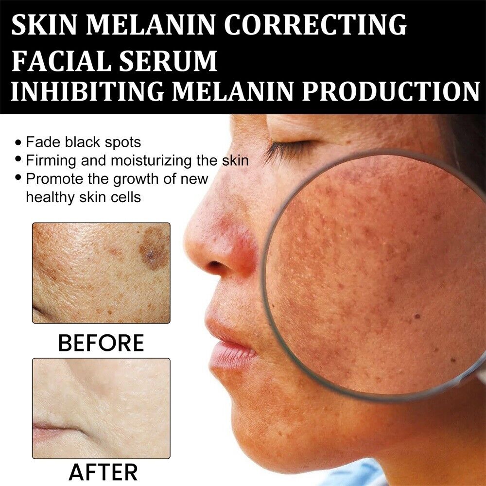 Tiworld™ Melanin Correcting Facial Serum-Fast Dark Spot Remover